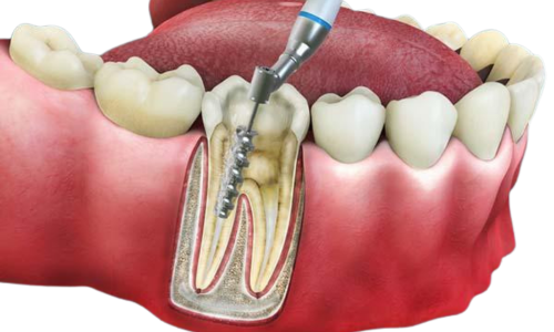 Root Canal Symptoms